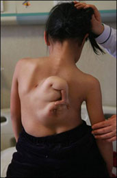 Niña de 11 años con un feto en su espalda