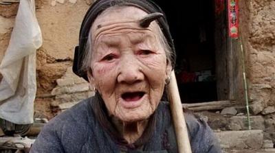 A una anciana china le brotó un cuerno de cabra en la frente